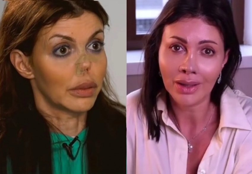 Алиса Казьмина полностью восстановила нос, который был обезображен из-за болезни